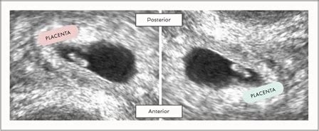 la méthode ramzi|Análisis de la placenta: Conoce el sexo del bebé con el método。